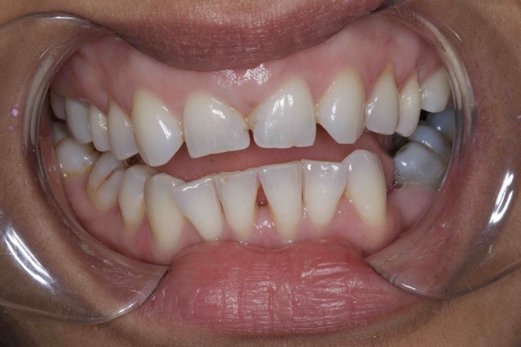 Before and After Dental Bonding Photos Cosmetic Bonding Dentists