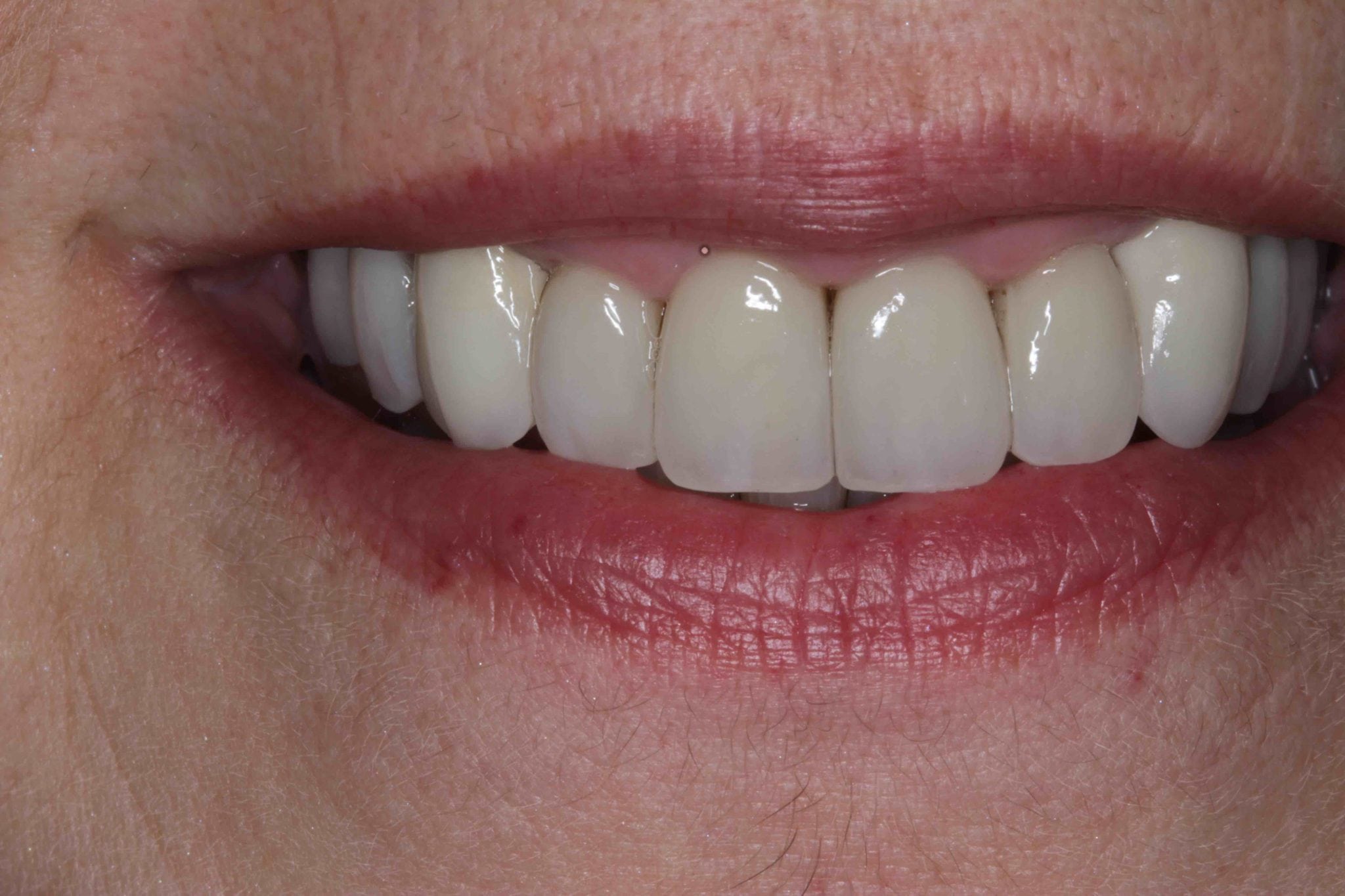 Smile MakeOver Before After with Porcelain Crowns