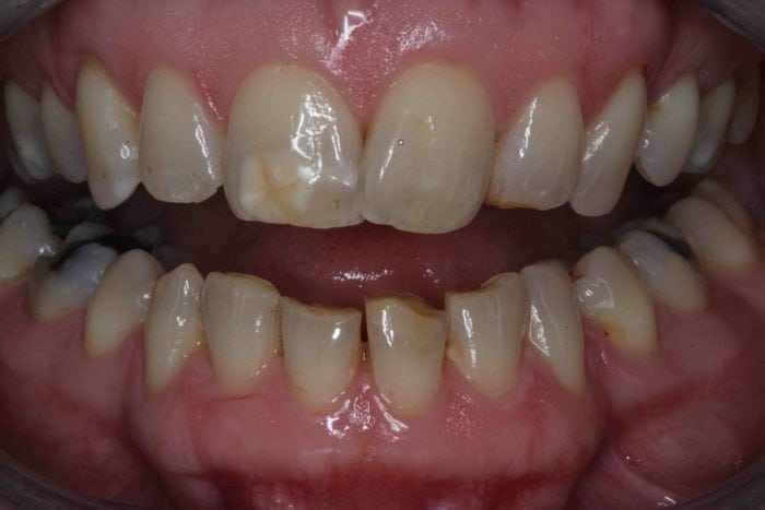 teeth translucent