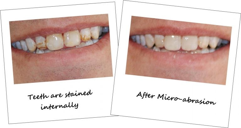 Cosmetic Dentistry Preston - Before and after Pictures