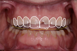 tooth wear treatment