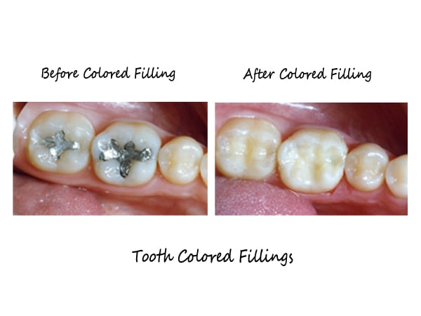 tooth coloured fillings before and after pictures