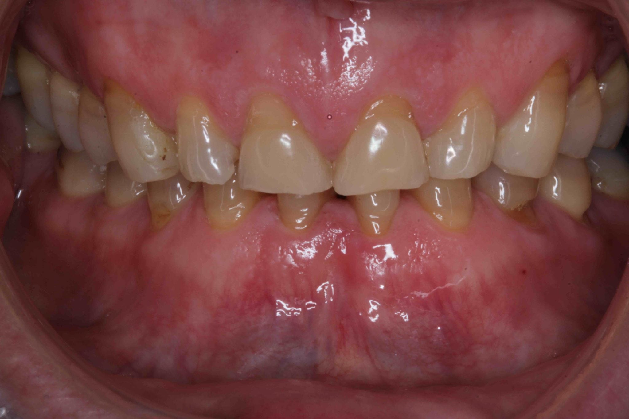 Worn teeth smile makeover before and after pictures