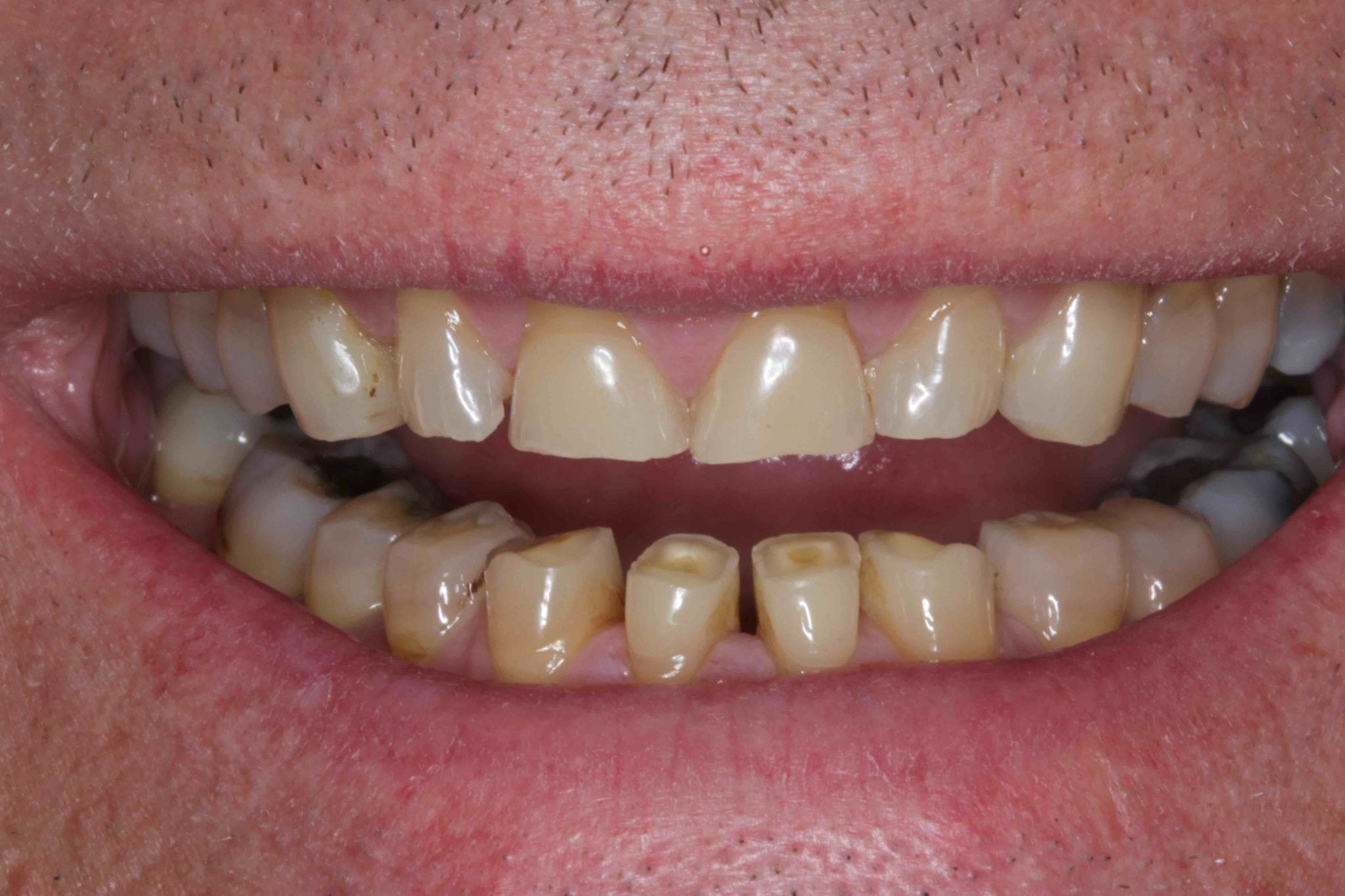 mini smile makeover eroded teeth before and after photod