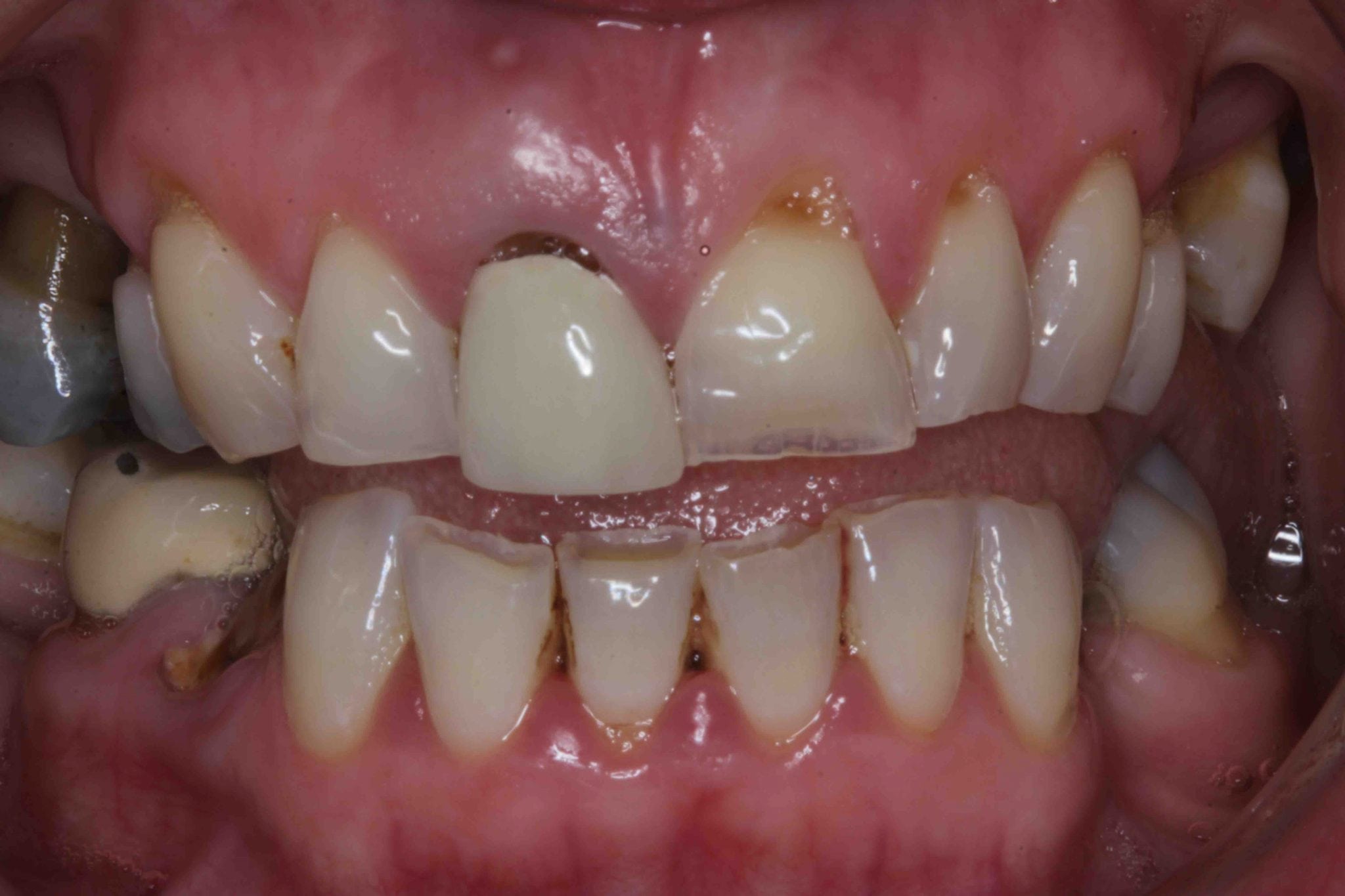 fractured tooth dental implant treatment photos