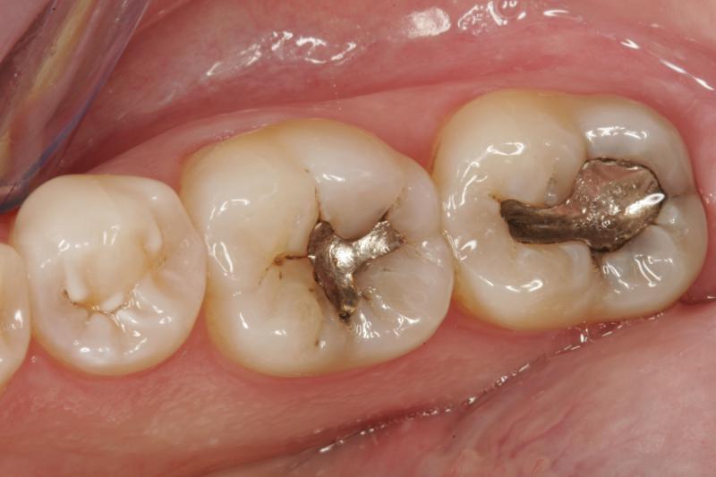 white fillings before and after photos