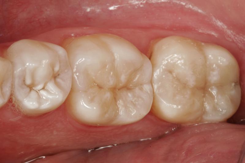 white fillings replacement before and after photos