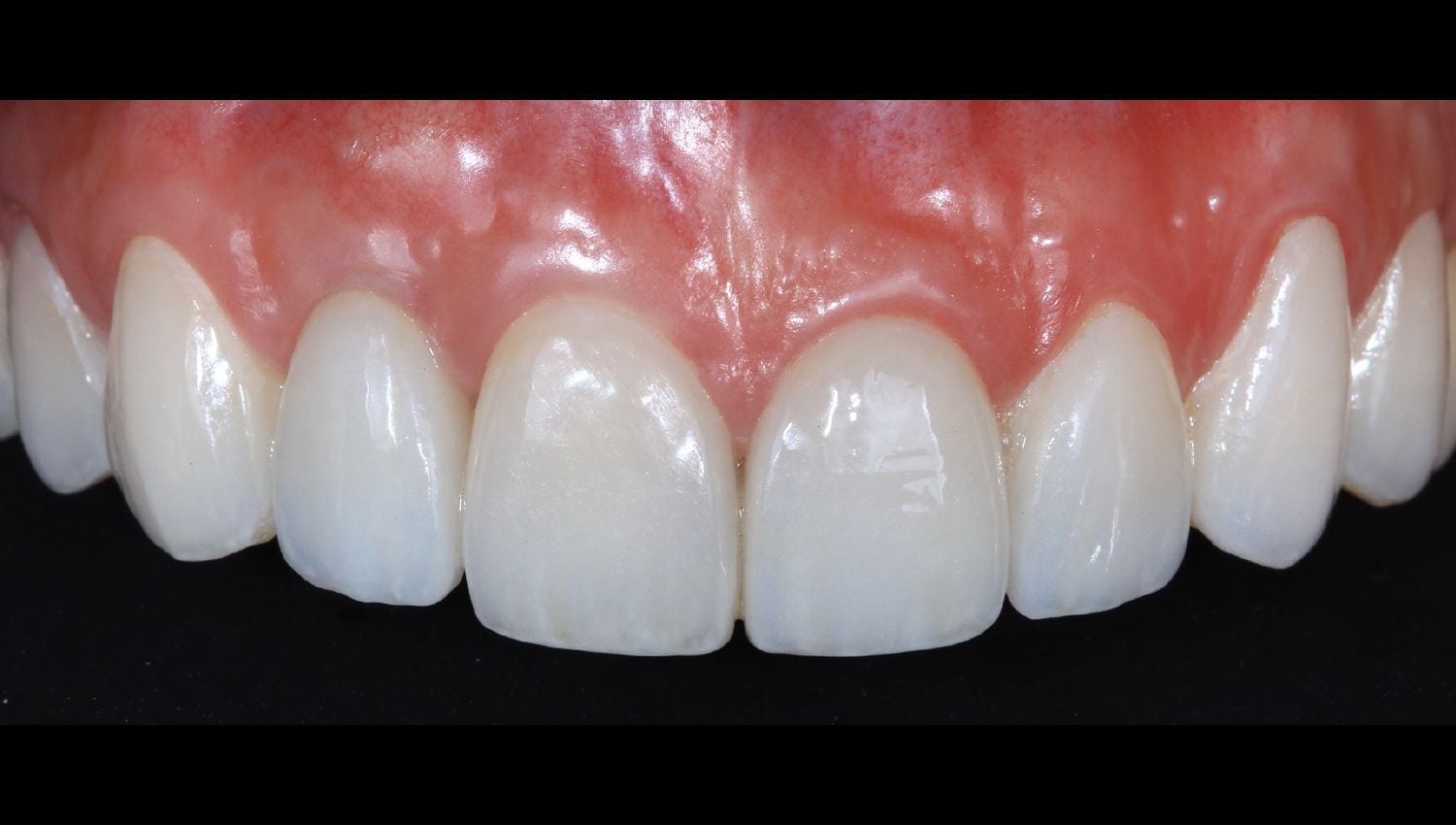 Dental Implants before and after photos - broken front tooth