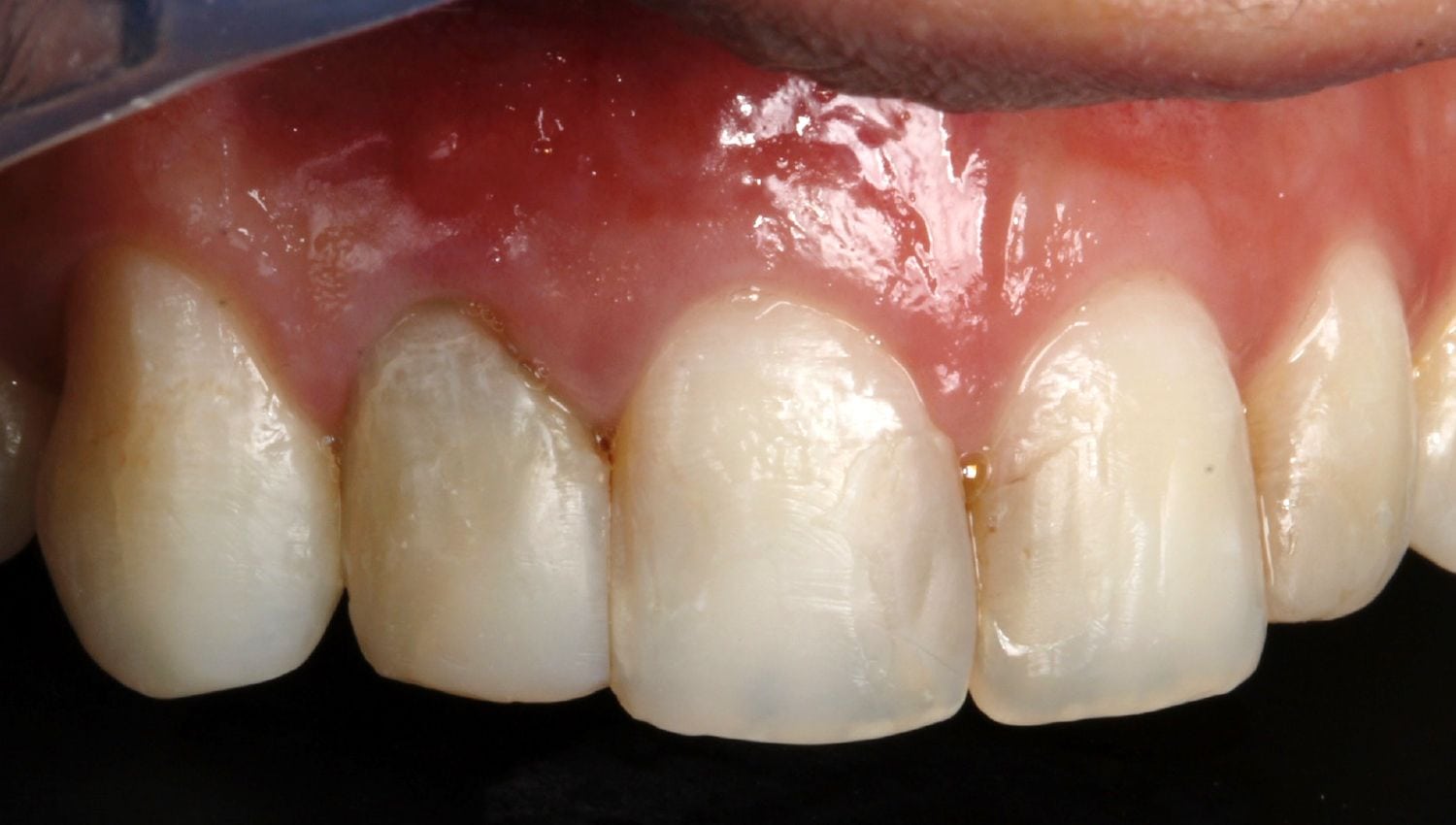 Dental Implants before and after photos - broken front tooth