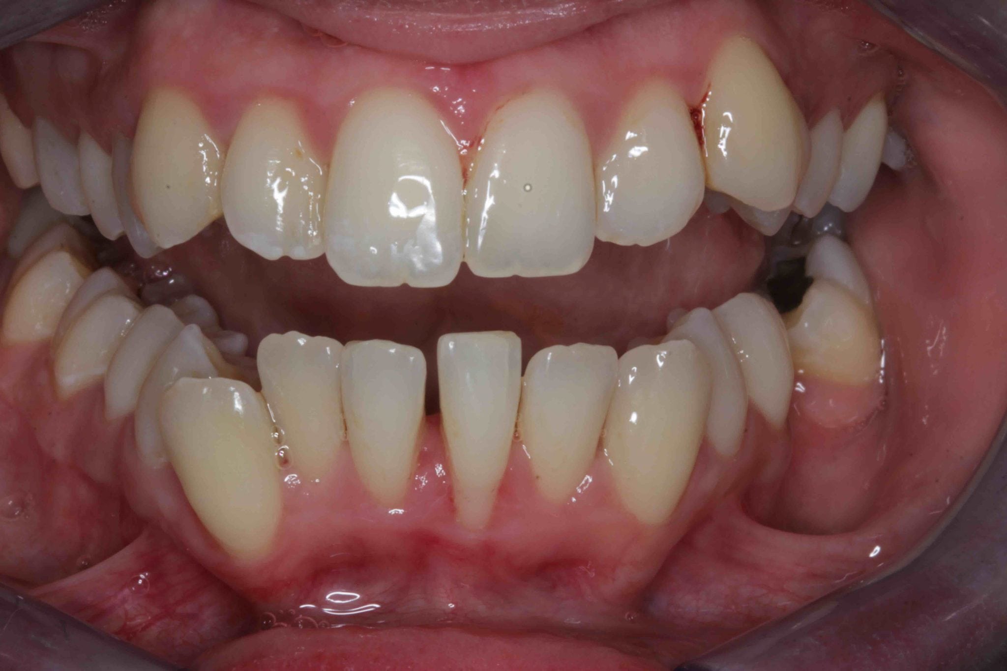 Braces and Porcelain veneers before treatment photo