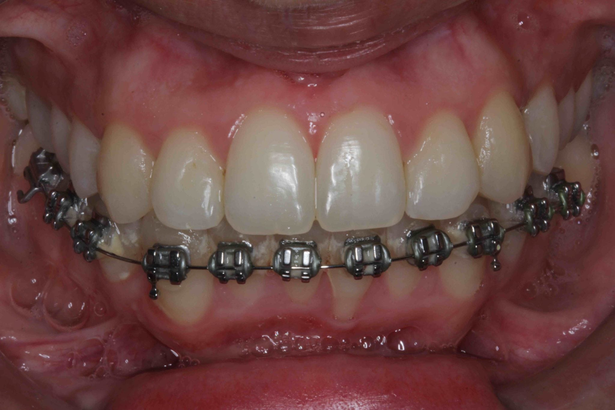 Dental Veneers and Bridge After Orthodontic Braces