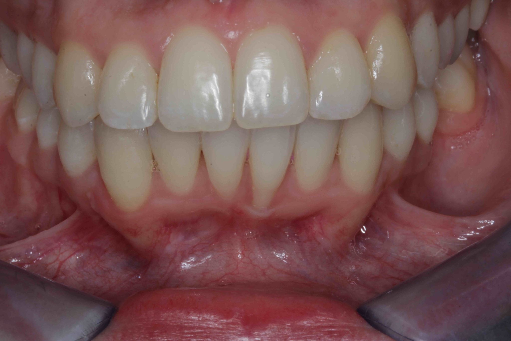 fixing crooked teeth with braces and veneers before after pictures