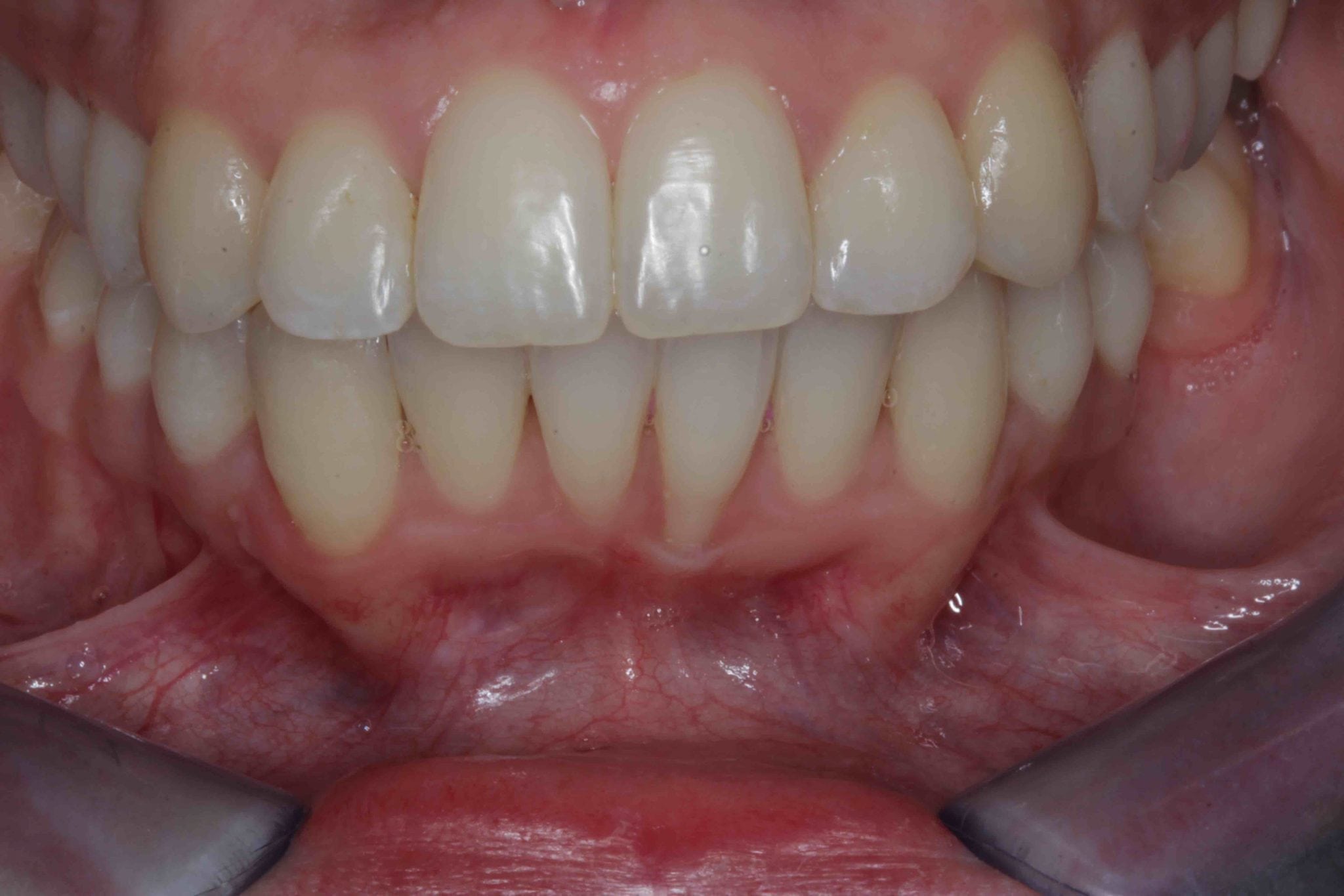 Dental Veneers and Bridge After Orthodontic Braces