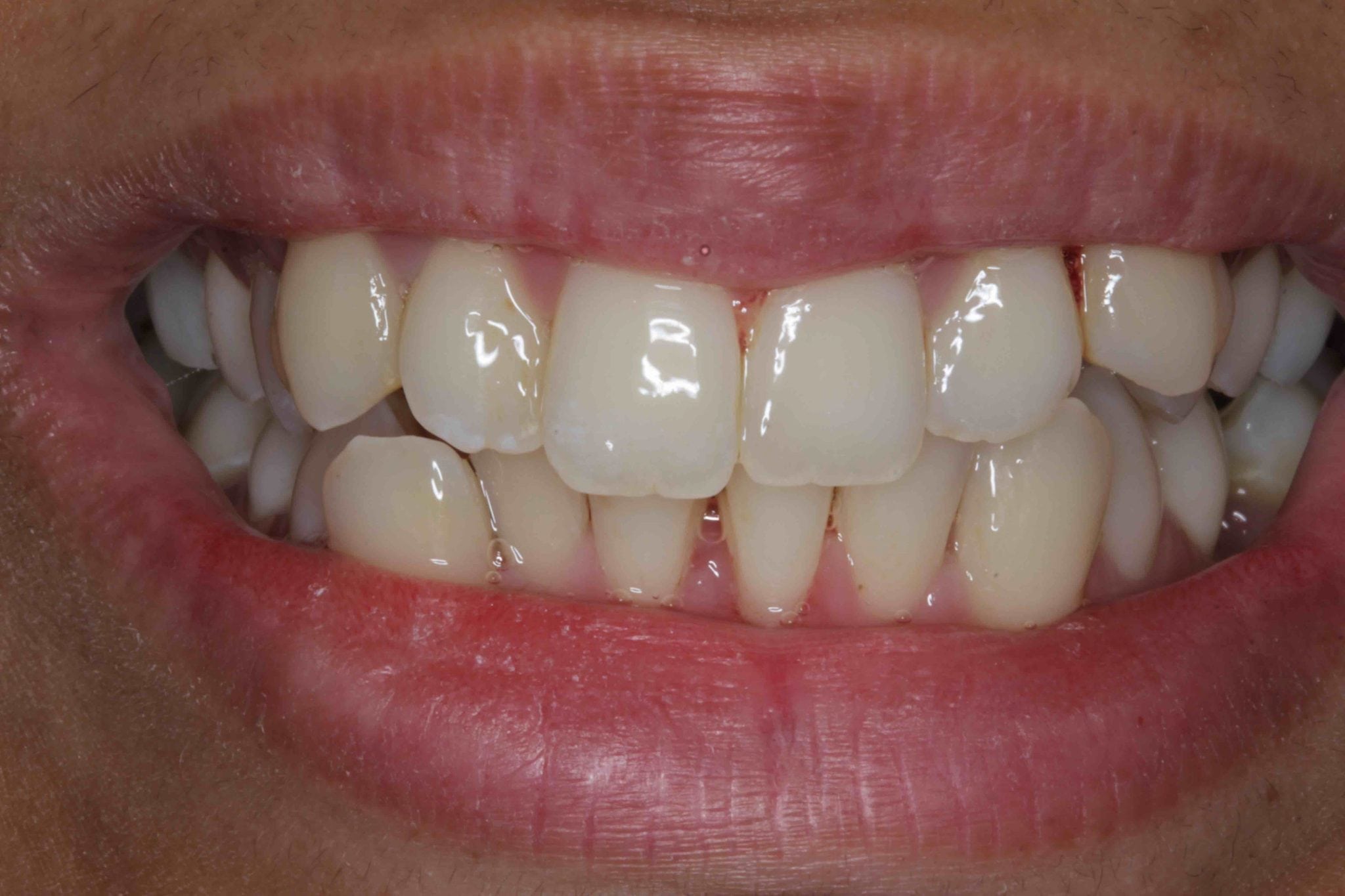 crooked teeth treatment with porcelain veneers before after