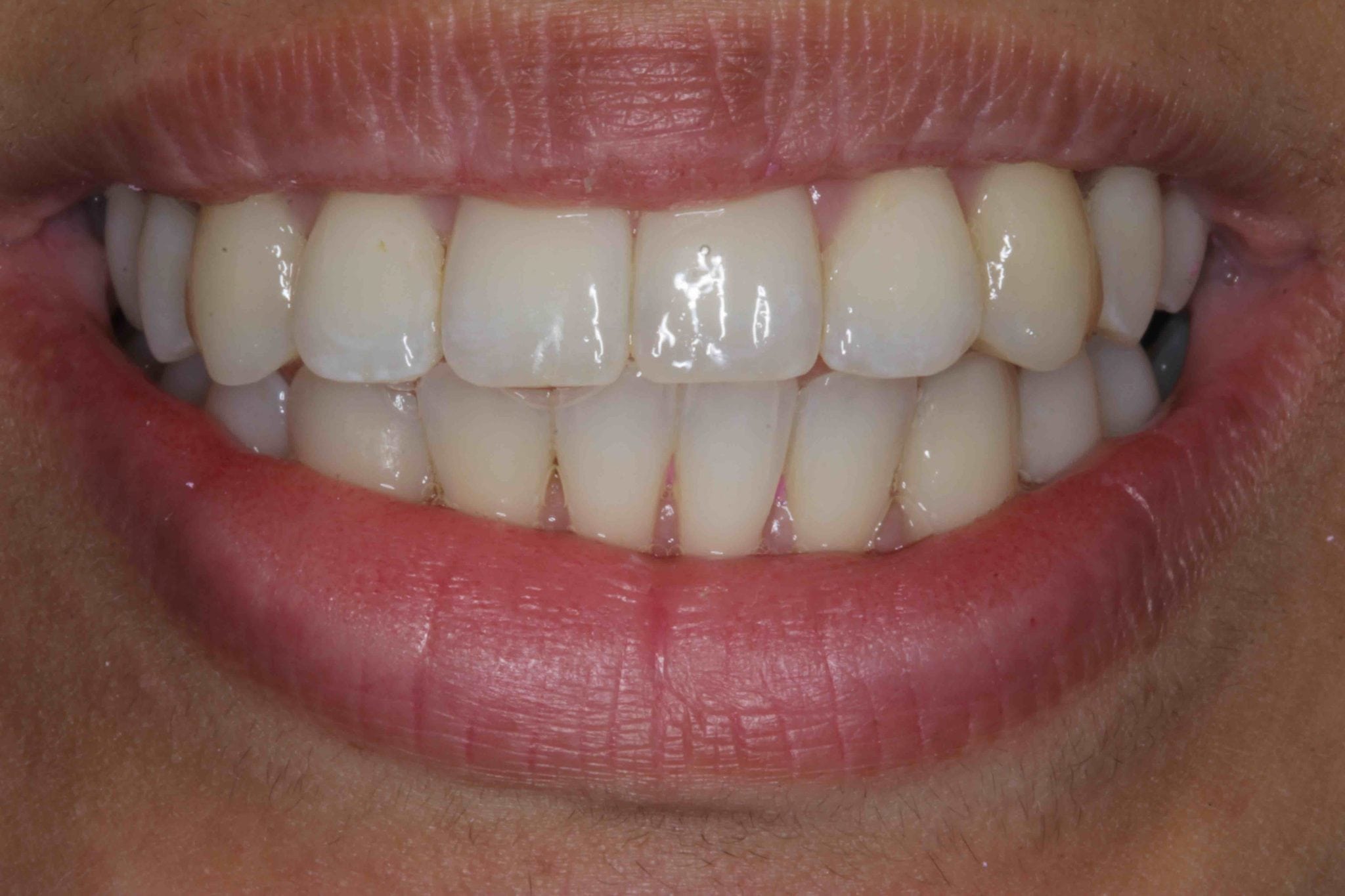 cosmetic teeth straightening with dental veneers after pictures