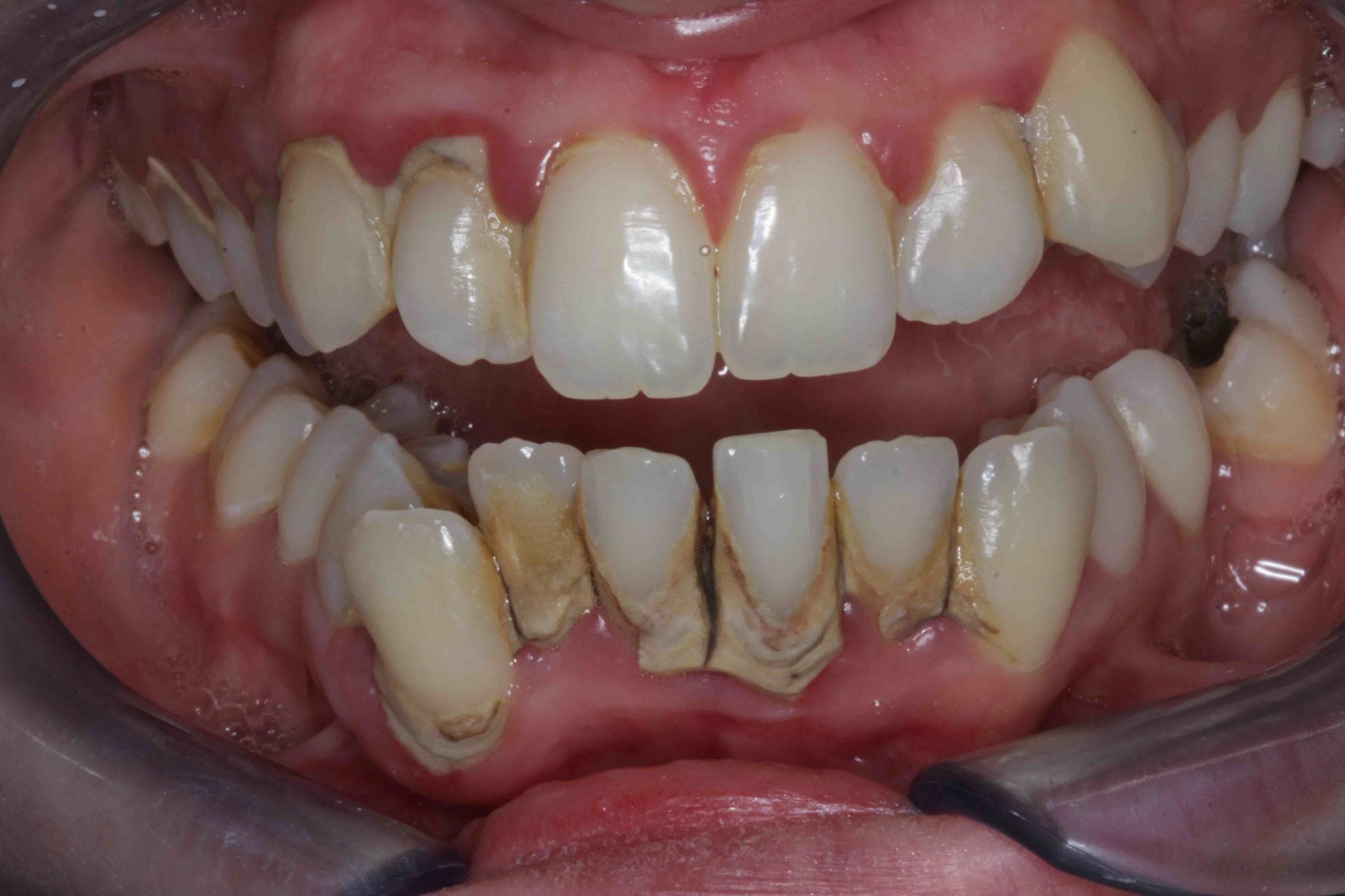 Crooked Teeth Veneers Before And After TeethWalls