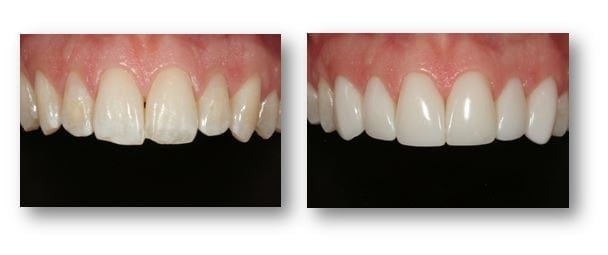 Best Composite Veneers in Preston , Lancashire - Lane ends dental Practice