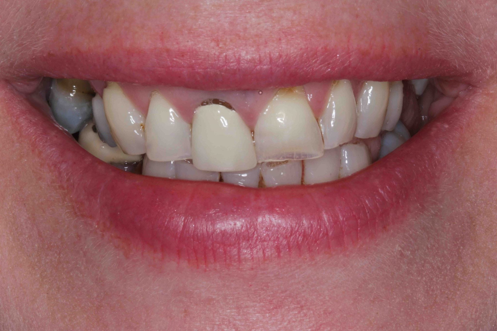 single dental implant replacing a broken upper front tooth - before photo