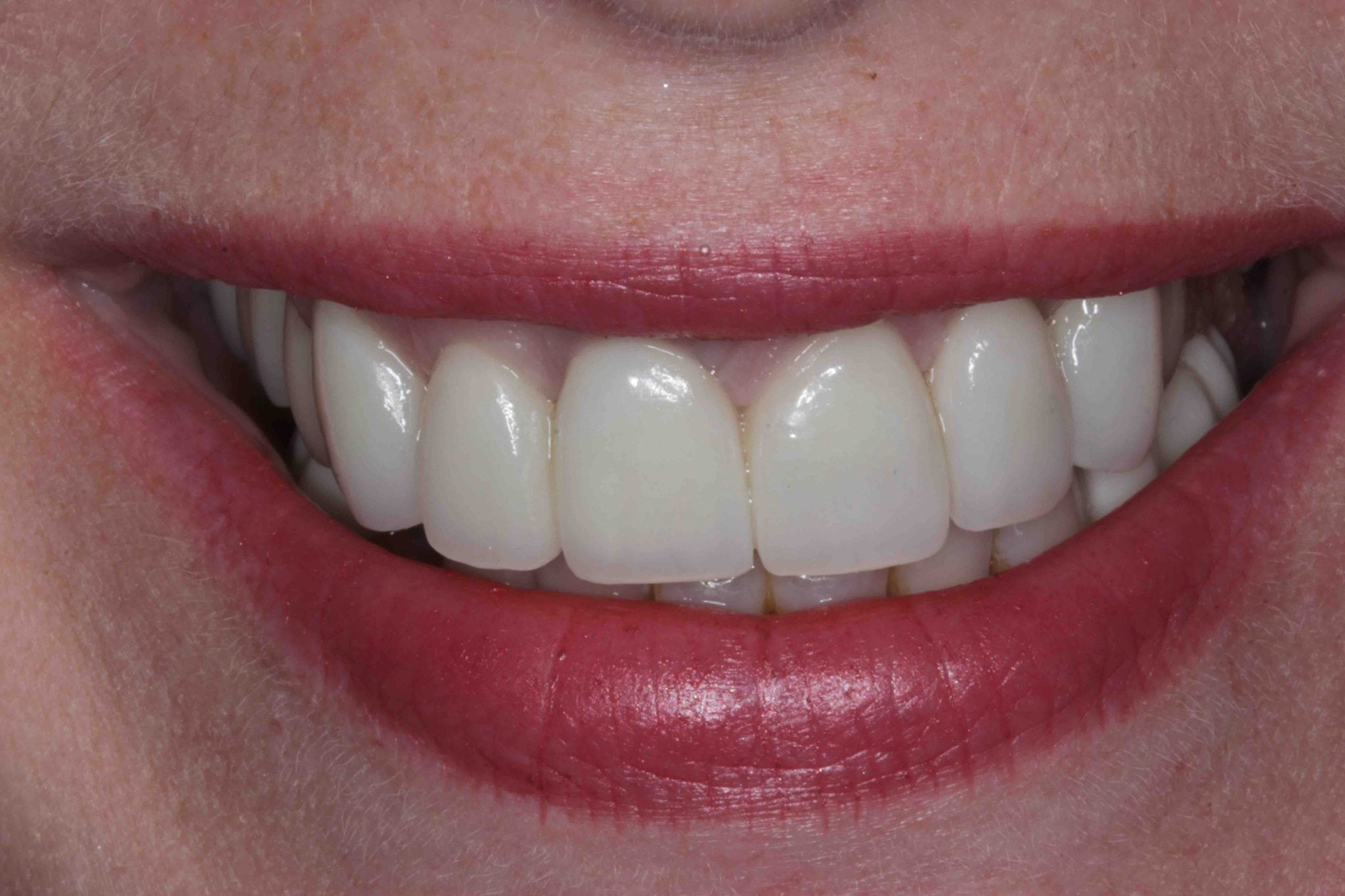 Replacement of Fractured Tooth with Dental Implant  in upper front - before after images