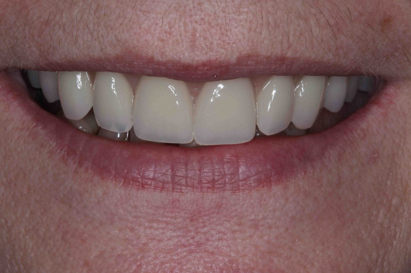 Dental Implants Before And After Lane Ends Dental Practice Preston   Full Upper Denture After Implants Image 1400x933 