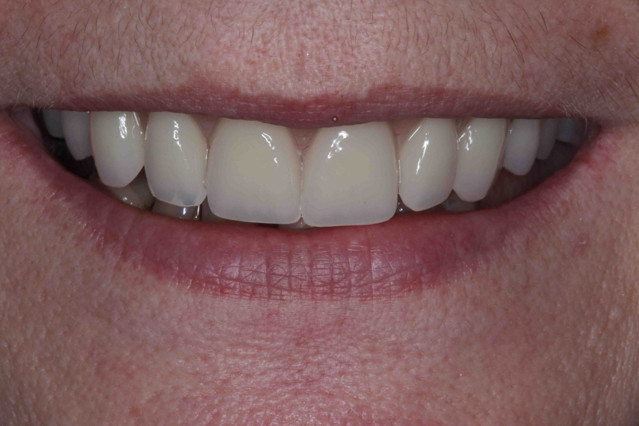 implant dentures after photo