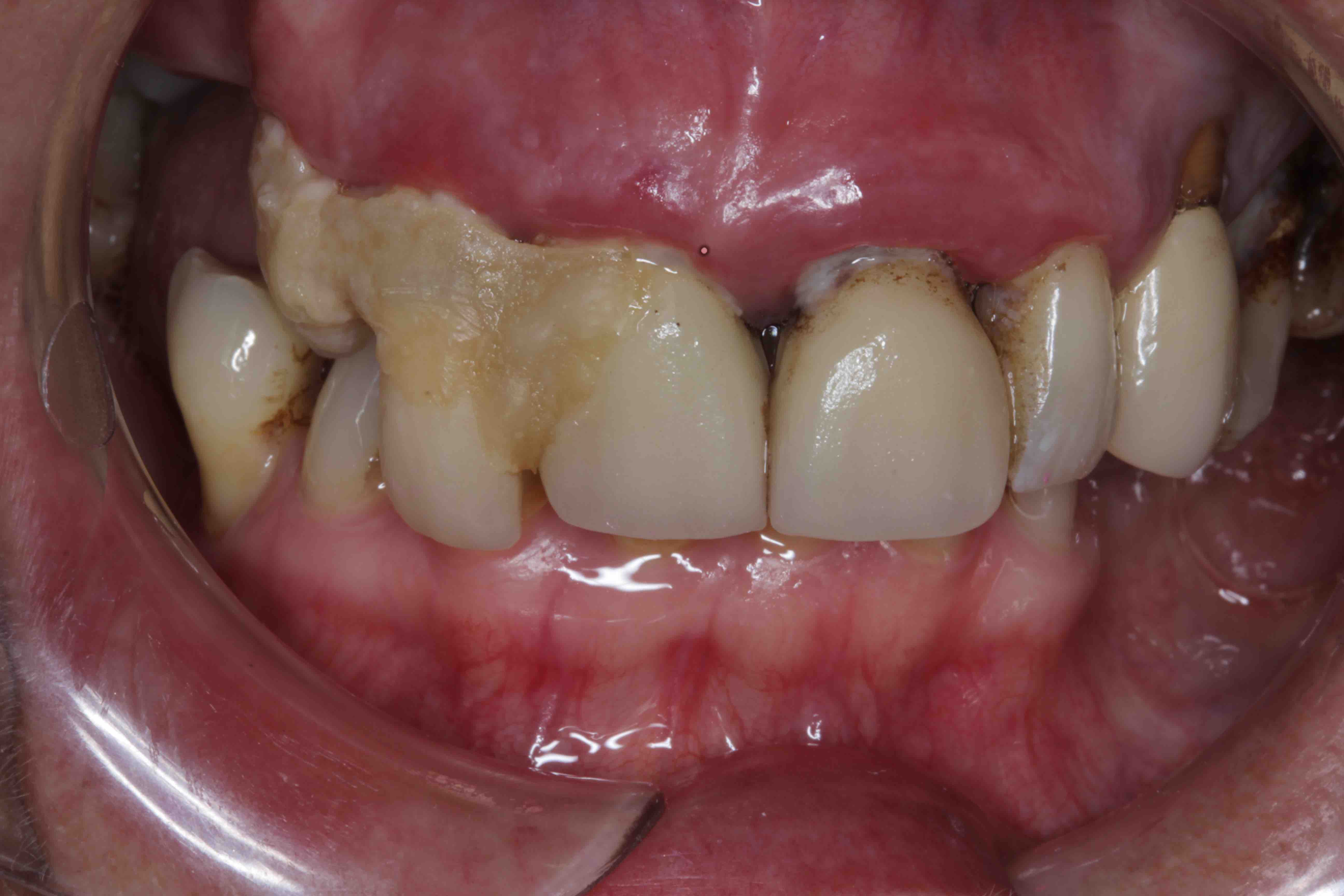 implant dentures before photo