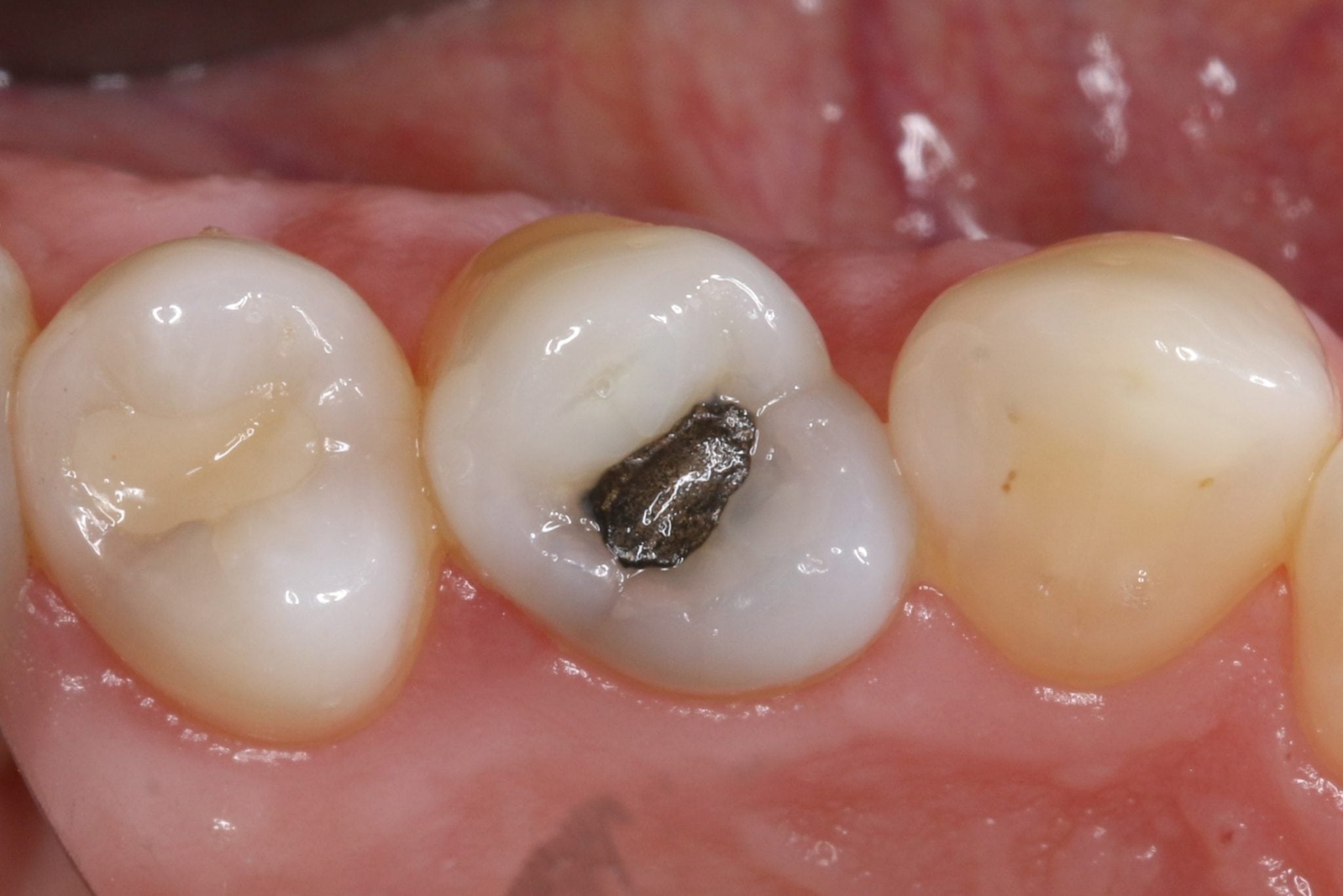 amalgam filling before replacement image