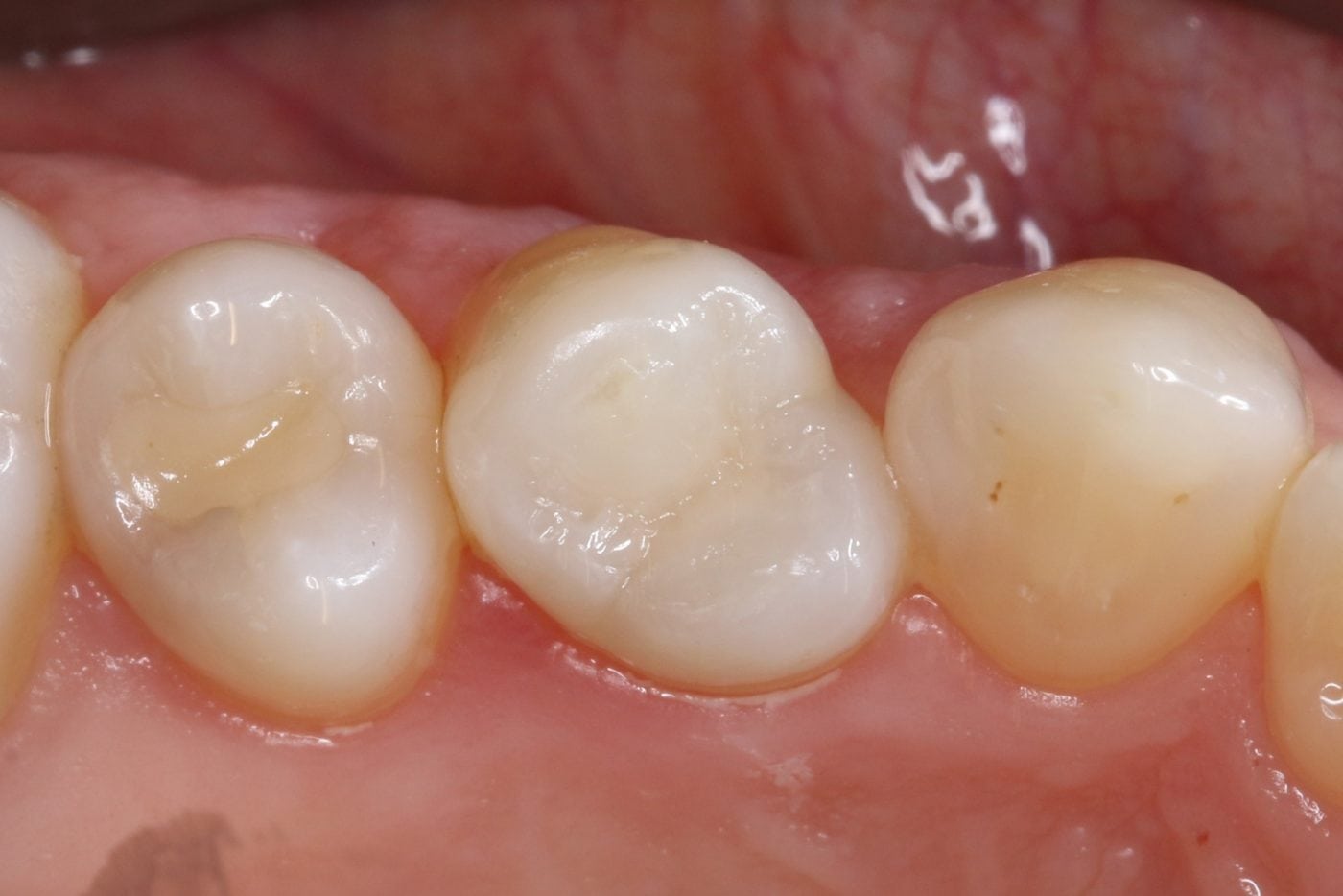 White Fillings Before and After photos - Front Tooth Composite Fillings