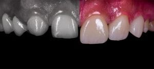 Dental Veneers before and After photos