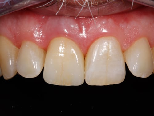 Front Tooth After Dental implant photo