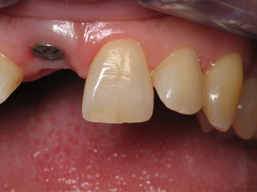 Front Tooth before Dental implant photo