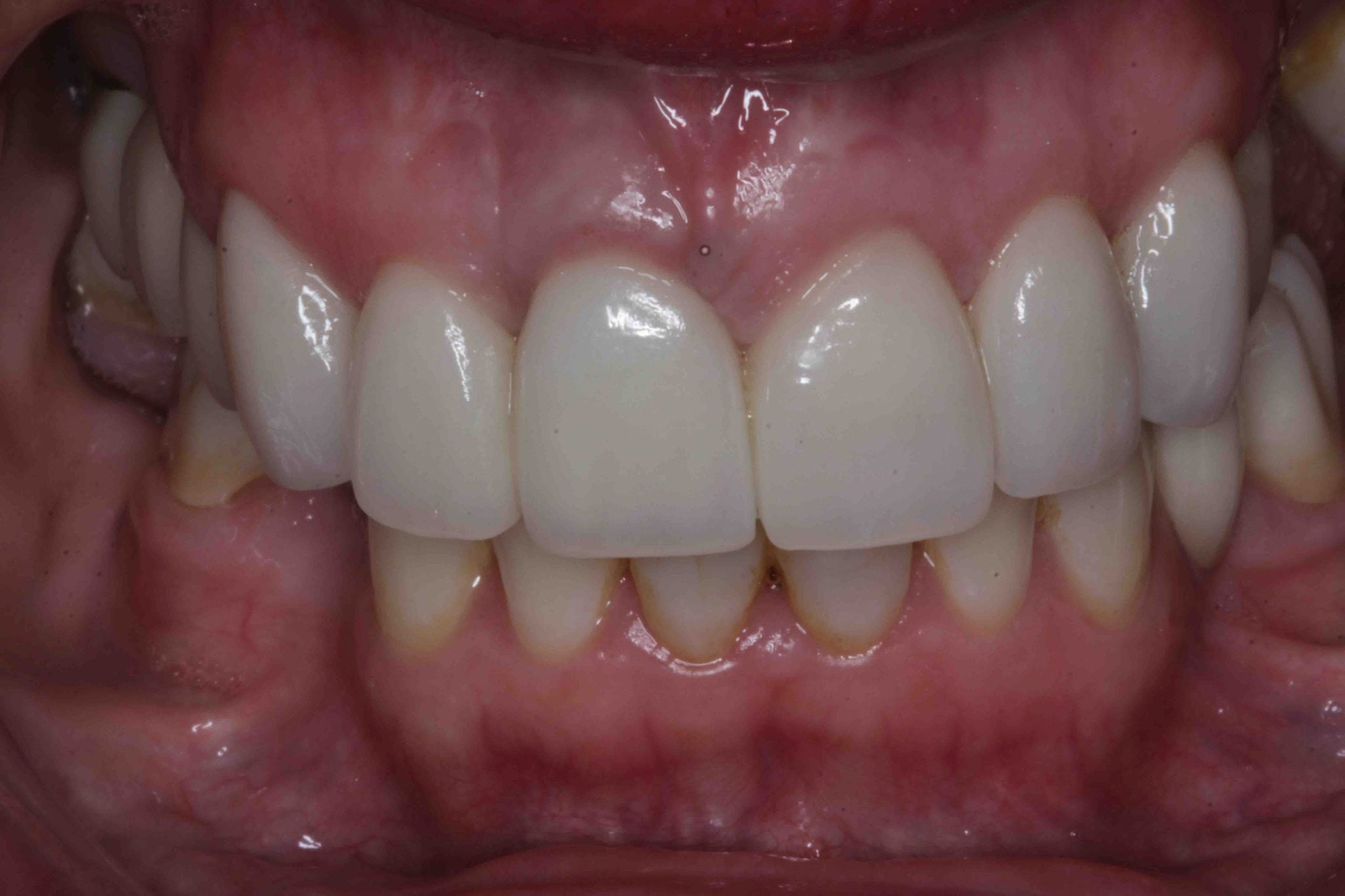 Front Tooth dental Implants before and After photos