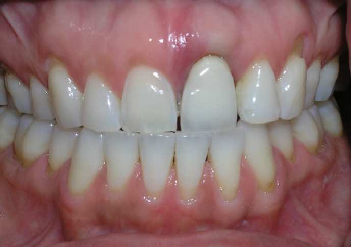 Front Tooth Dental Implants Before and After