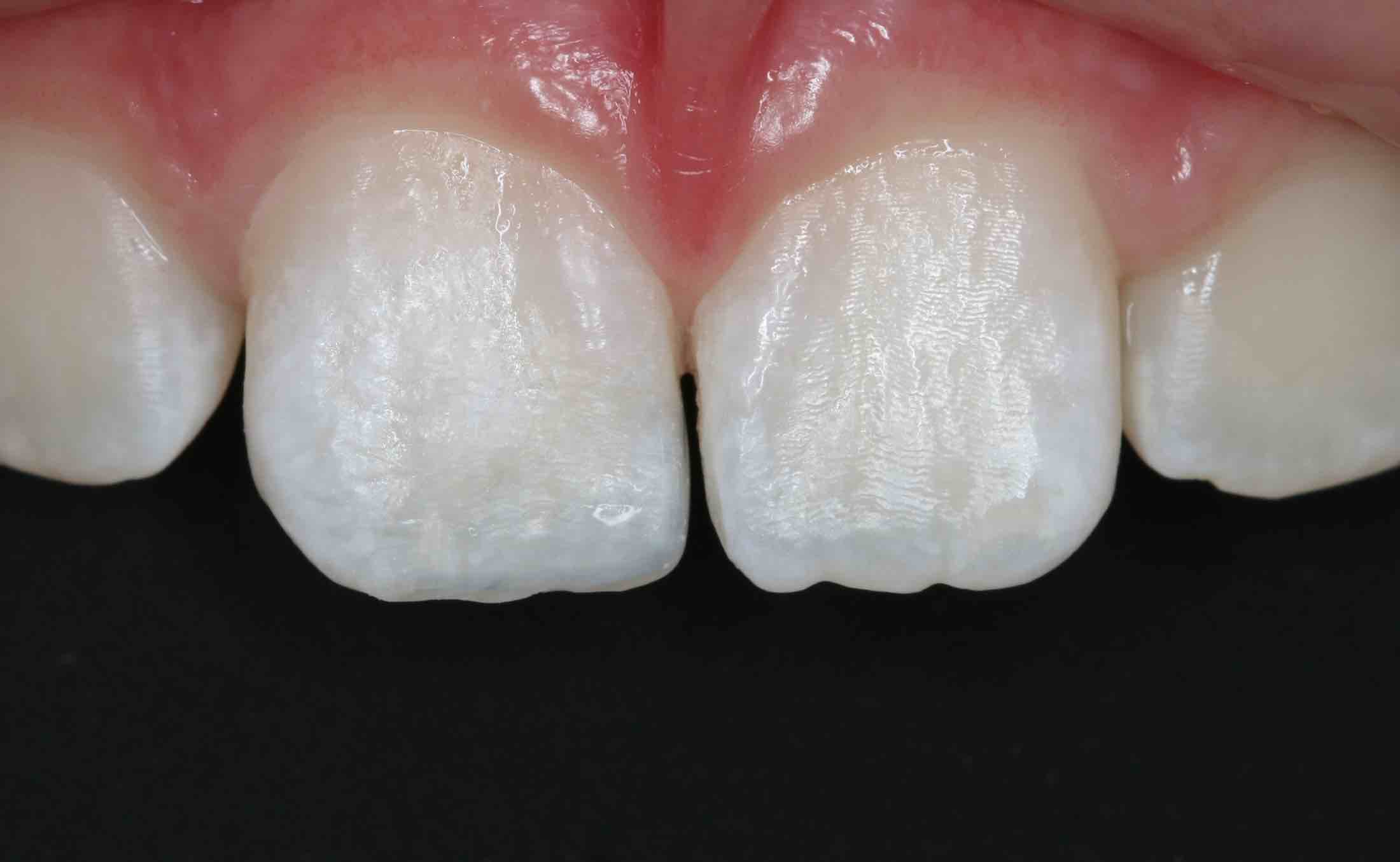 Before and After White Fillings in Front Teeth pictures