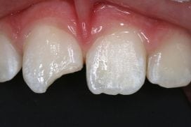 White Fillings Before and After photos - Front Tooth Composite Fillings