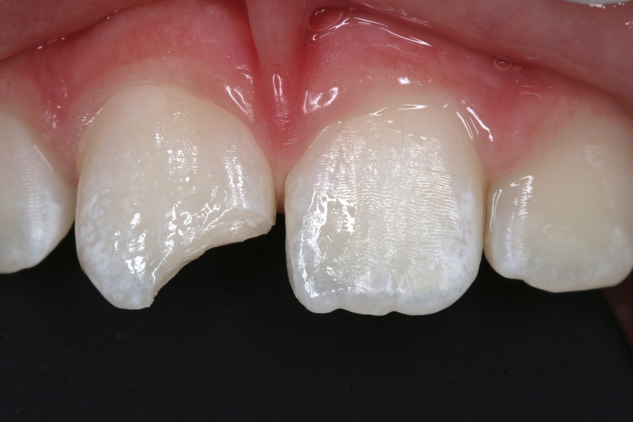 When should a tooth filling be replaced?