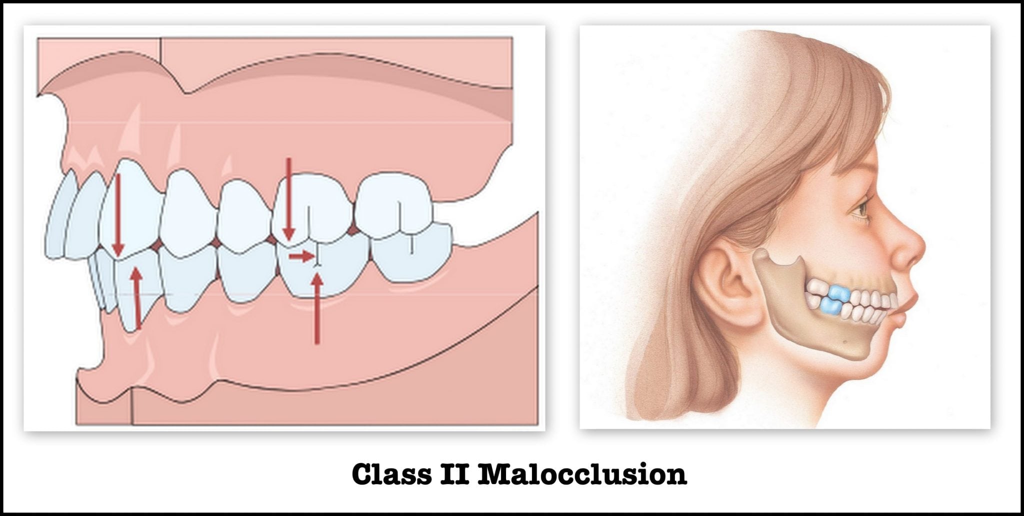 Class 2 Maloccusion  