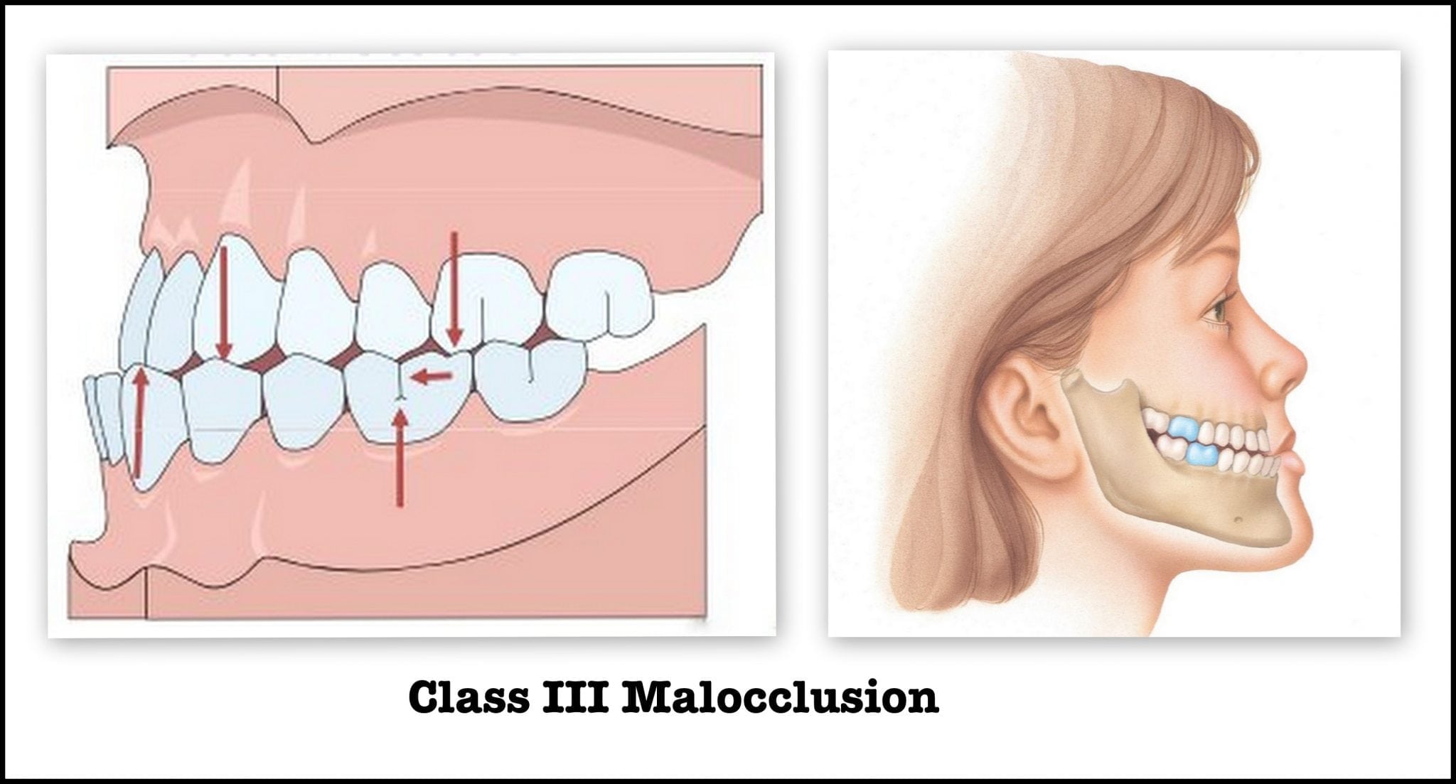 TMJ Symptoms and Treatment