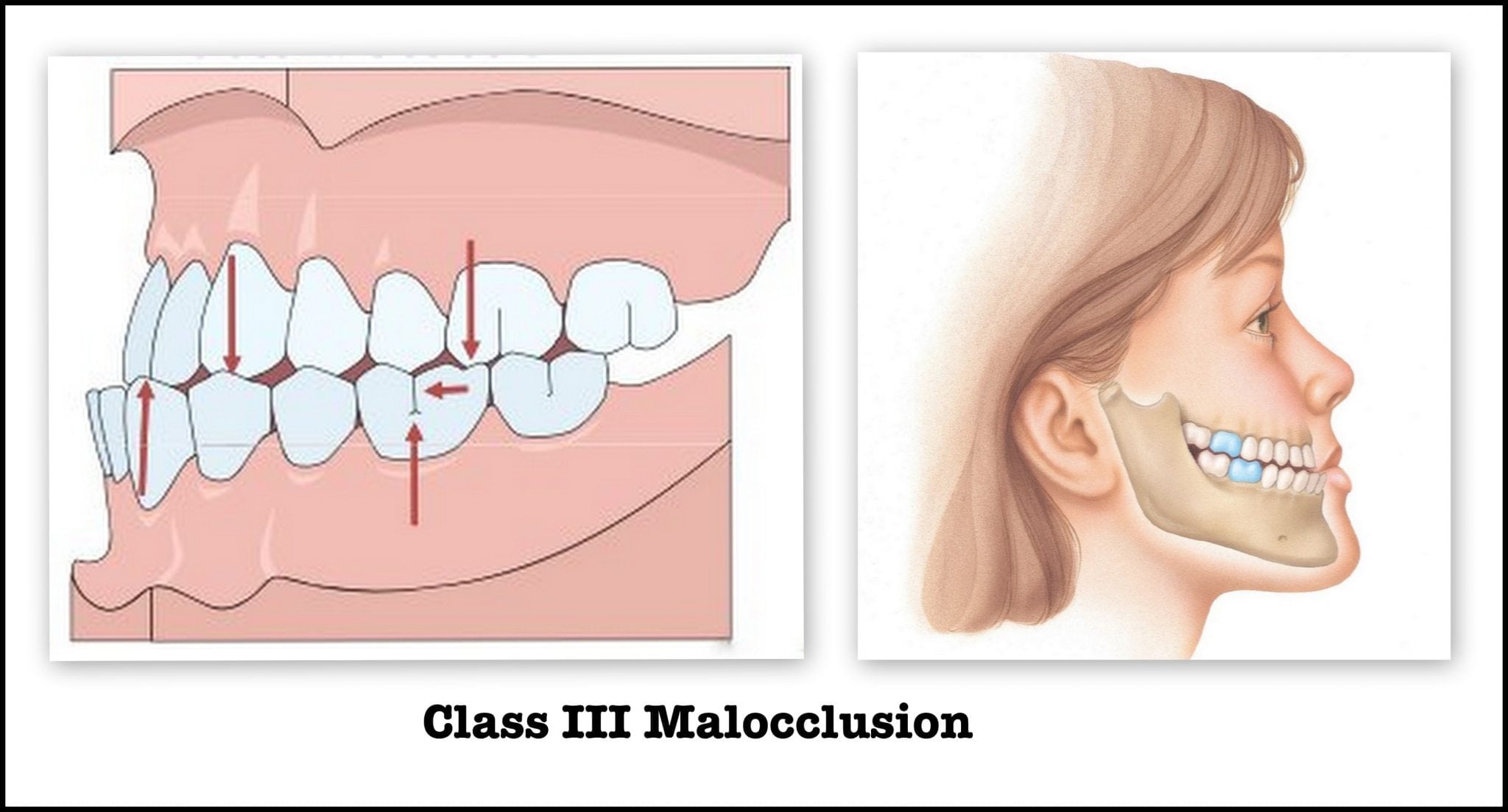 class 3 malocclusion - 5 Usual Reasons For Tooth Staining