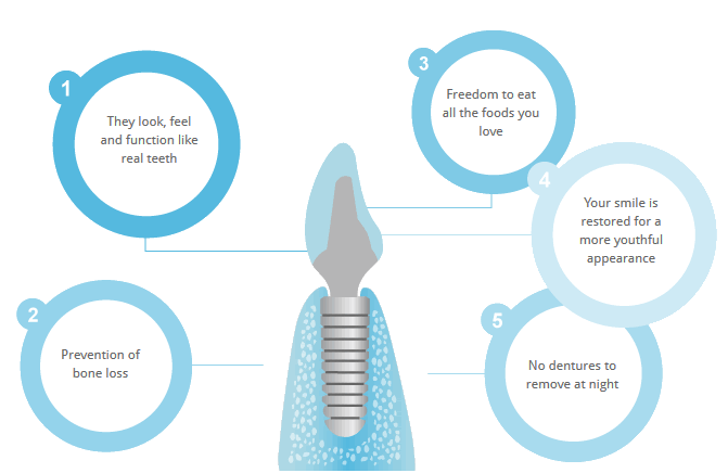 Benefits of Dental Implants