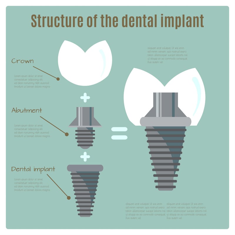 Dental Implant Procedure