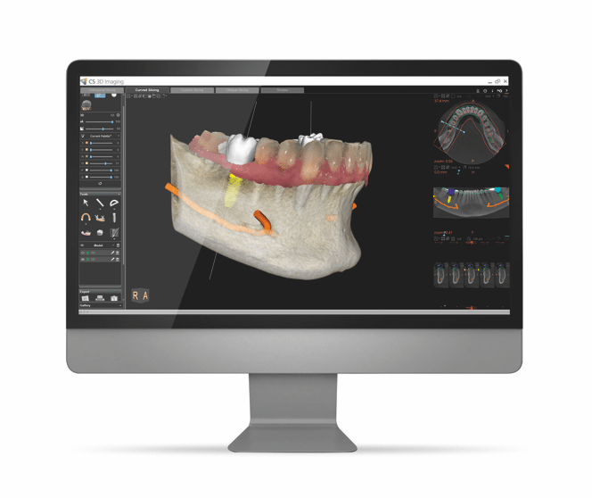 During Dental Implants surgery