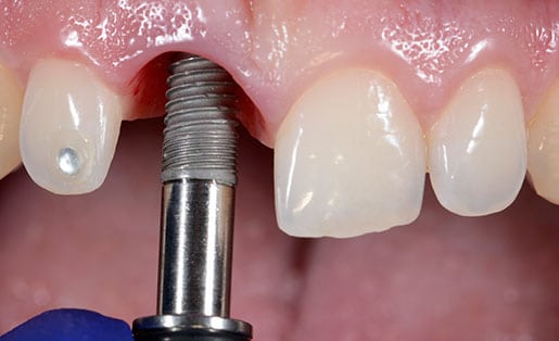 dental implant surgery picture