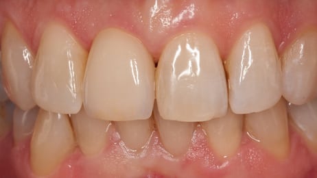 front tooth single implant after image