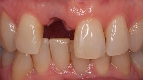 missing front tooth before image