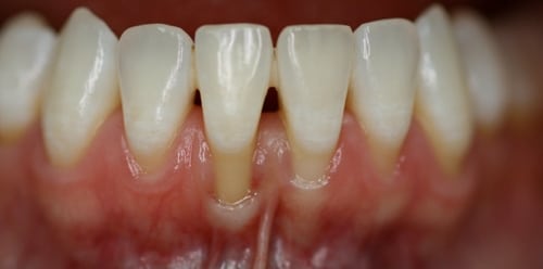Receded gums on Front Teeth 