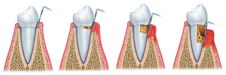 Receding Gums Causes