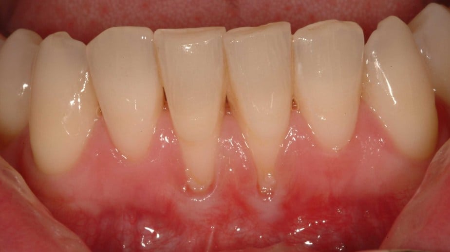 Receding Gums in Gum Disease