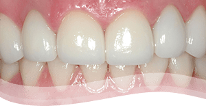 Tooth Veneers Process after - severely discoloured tooth treatment