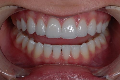 teeth veneers procedure